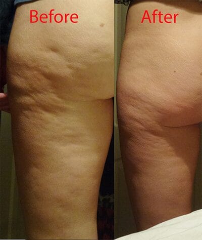 Cellulite Therapy Result
