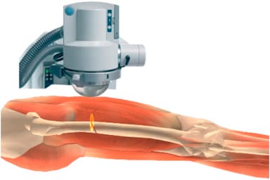Delayed Unions and Non Unions