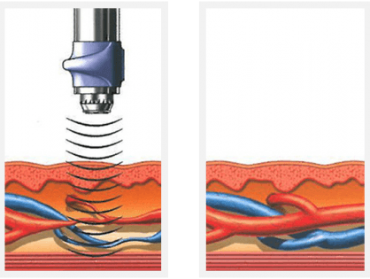 Erectile Dysfunction