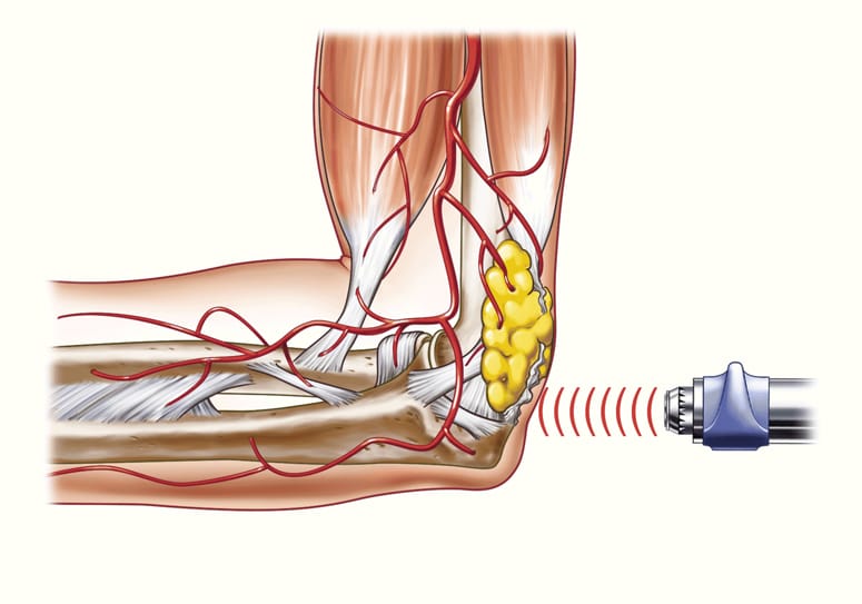 muscle strain shockwave